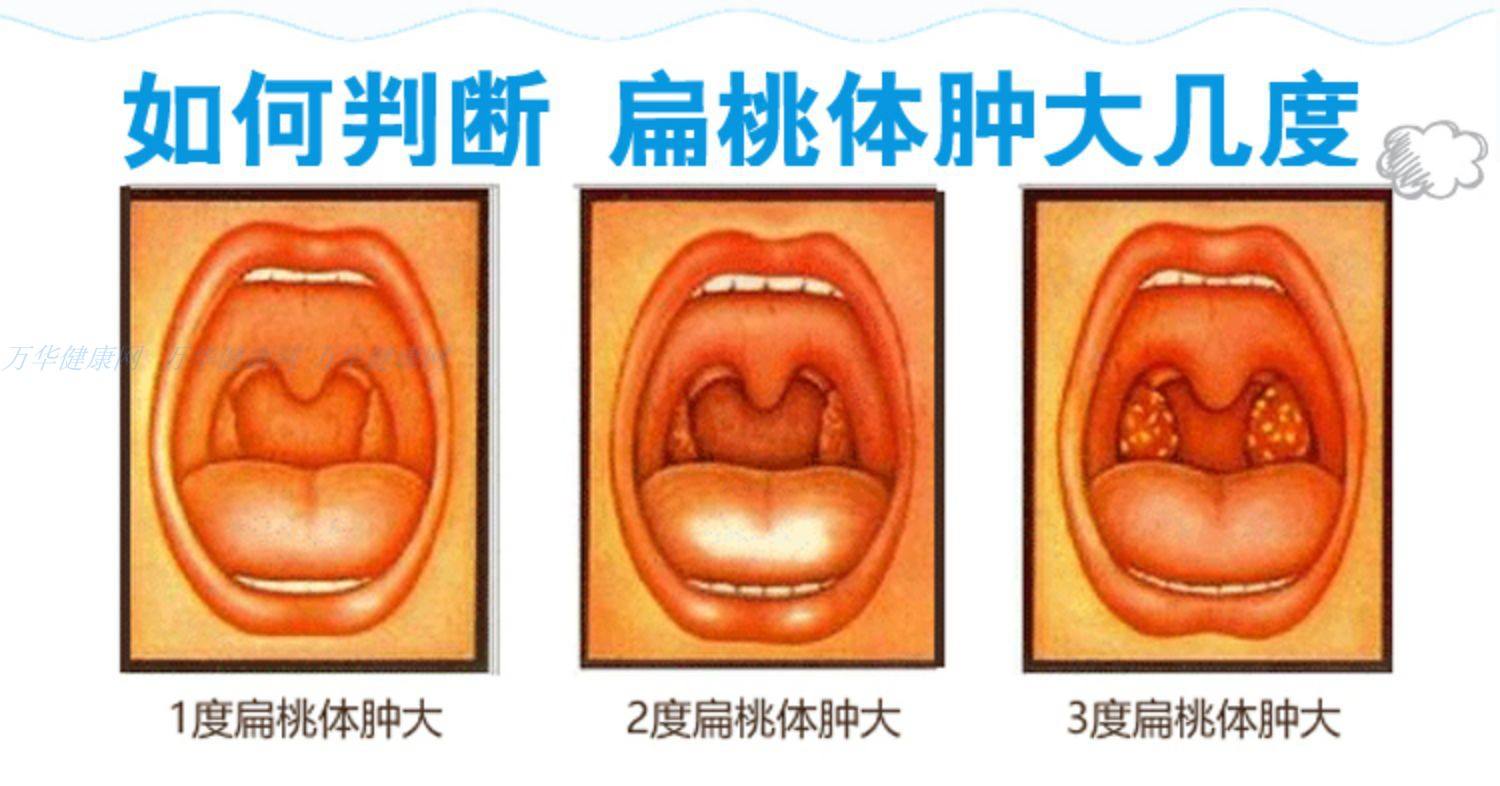 扁桃体肿大怎么办(8岁孩子扁桃体肿大怎么办)