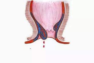产妇生痔疮怎么办(产妇得了痔疮怎么治)