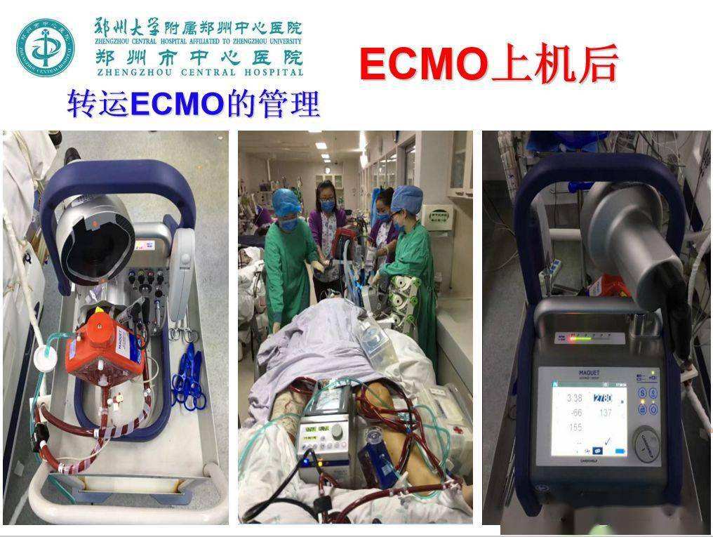 Ecmo医学上是什么意思(ecmo医学上是什么意思怎么读)