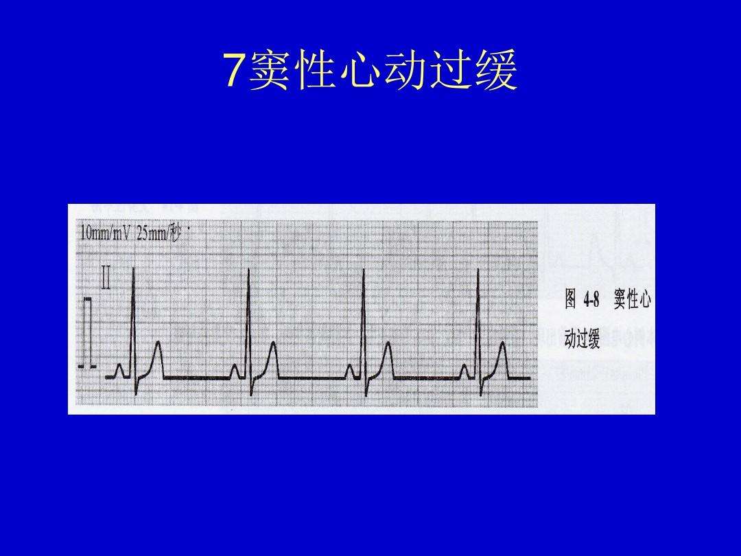 窦性心动过缓怎么办(窦性心动过缓怎么办,全胸导联低电压怎么办)