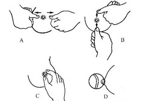 乳头内陷怎么办 