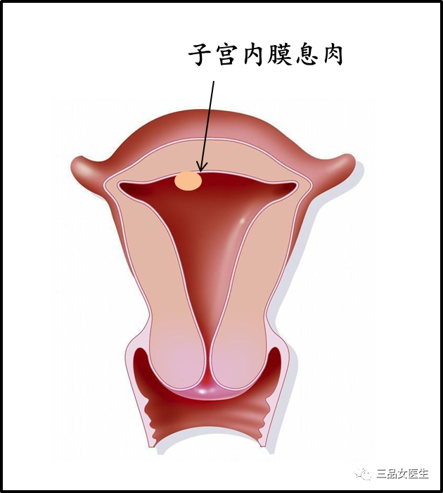 子宫消化吸收图片