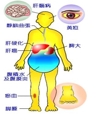 为什么会得肝硬化(为什么会得肝硬化腹水)